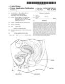 INCONTINENCE TREATMENT DEVICE CONFIGURED FOR URETHRAL PLACEMENT INTO THE     BLADDER diagram and image