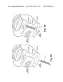 INCONTINENCE TREATMENT DEVICE CONFIGURED FOR URETHRAL PLACEMENT INTO THE     BLADDER diagram and image