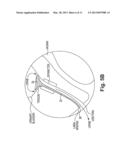 INCONTINENCE TREATMENT DEVICE CONFIGURED FOR URETHRAL PLACEMENT INTO THE     BLADDER diagram and image