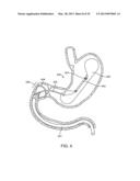 INTRAGASTRIC IMPLANT DEVICES diagram and image