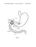 INTRAGASTRIC IMPLANT DEVICES diagram and image