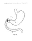 INTRAGASTRIC IMPLANT DEVICES diagram and image