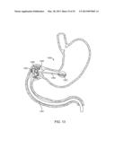 INTRAGASTRIC IMPLANT DEVICES diagram and image