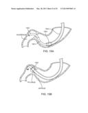 INTRAGASTRIC IMPLANT DEVICES diagram and image