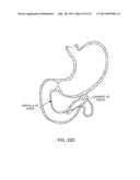 INTRAGASTRIC IMPLANT DEVICES diagram and image