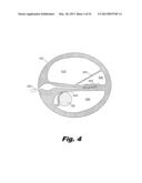 Modular Drug Delivery System for Minimizing Trauma During and After     Insertion of a Cochlear Lead diagram and image