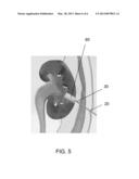 PERCUTANEOUS NEPHROSTOMY PLUG DELIVERY DEVICE diagram and image