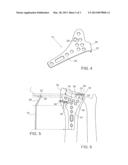 Distal Radius Volar Locking Plate With Extension for Ulnar Volar Fragment diagram and image