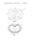 FIXED-BEARING KNEE PROSTHESIS HAVING A LOCKING MECHANISM WITH A     CONCAVE-TO-CONVEX MATING INTERFACE diagram and image