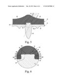 FIXED-BEARING KNEE PROSTHESIS HAVING A LOCKING MECHANISM WITH A     CONCAVE-TO-CONVEX MATING INTERFACE diagram and image