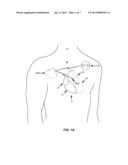 THERAPY CONTROL BASED ON NIGHTTIME CARDIOVASCULAR PRESSURE diagram and image