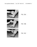 SYSTEM AND METHOD FOR TREATING LEG ULCERS diagram and image