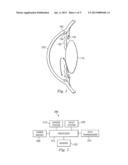 Selectable Varied Control Valve Systems For IOP Control Systems diagram and image