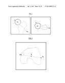 METHOD FOR DETERMINING ARTICULAR BONE DEFORMITY RESECTION USING MOTION     PATTERNS diagram and image