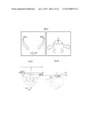 METHOD FOR DETERMINING ARTICULAR BONE DEFORMITY RESECTION USING MOTION     PATTERNS diagram and image