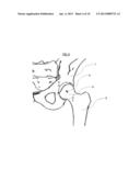 METHOD FOR DETERMINING ARTICULAR BONE DEFORMITY RESECTION USING MOTION     PATTERNS diagram and image