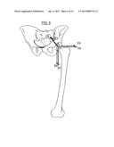 METHOD FOR DETERMINING ARTICULAR BONE DEFORMITY RESECTION USING MOTION     PATTERNS diagram and image