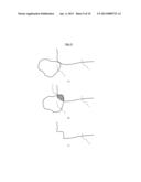 METHOD FOR DETERMINING ARTICULAR BONE DEFORMITY RESECTION USING MOTION     PATTERNS diagram and image