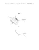 METHOD FOR DETERMINING ARTICULAR BONE DEFORMITY RESECTION USING MOTION     PATTERNS diagram and image