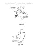 CUSHION FOR PATIENT INTERFACE diagram and image