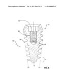 CONDENSING SKELETAL IMPLANT THAT FACILITATE INSERTIONS diagram and image