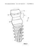 CONDENSING SKELETAL IMPLANT THAT FACILITATE INSERTIONS diagram and image