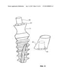 CONDENSING SKELETAL IMPLANT THAT FACILITATE INSERTIONS diagram and image