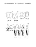 CONDENSING SKELETAL IMPLANT THAT FACILITATE INSERTIONS diagram and image