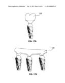 CONDENSING SKELETAL IMPLANT THAT FACILITATE INSERTIONS diagram and image