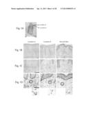 Biological Markers of Chronic Wound Tissue and Methods of Using for     Criteria in Surgical Debridement diagram and image