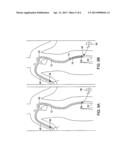 VASCULAR DELIVERY METHODS diagram and image