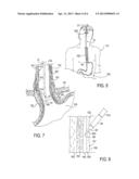 Method for Ablating Tissue to Facilitate Implantation and Apparatus and     Kit for Use Therewith diagram and image