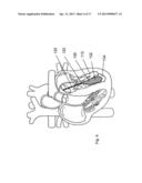 SYSTEMS AND METHODS FOR VOLUME REDUCTION diagram and image