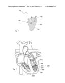 SYSTEMS AND METHODS FOR VOLUME REDUCTION diagram and image