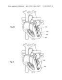 SYSTEMS AND METHODS FOR VOLUME REDUCTION diagram and image