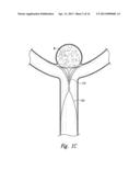 DEVICES, SYSTEMS AND METHODS FOR ENCLOSING AN ANATOMICAL OPENING diagram and image