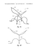 DEVICES, SYSTEMS AND METHODS FOR ENCLOSING AN ANATOMICAL OPENING diagram and image