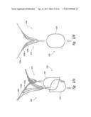 DEVICES, SYSTEMS AND METHODS FOR ENCLOSING AN ANATOMICAL OPENING diagram and image