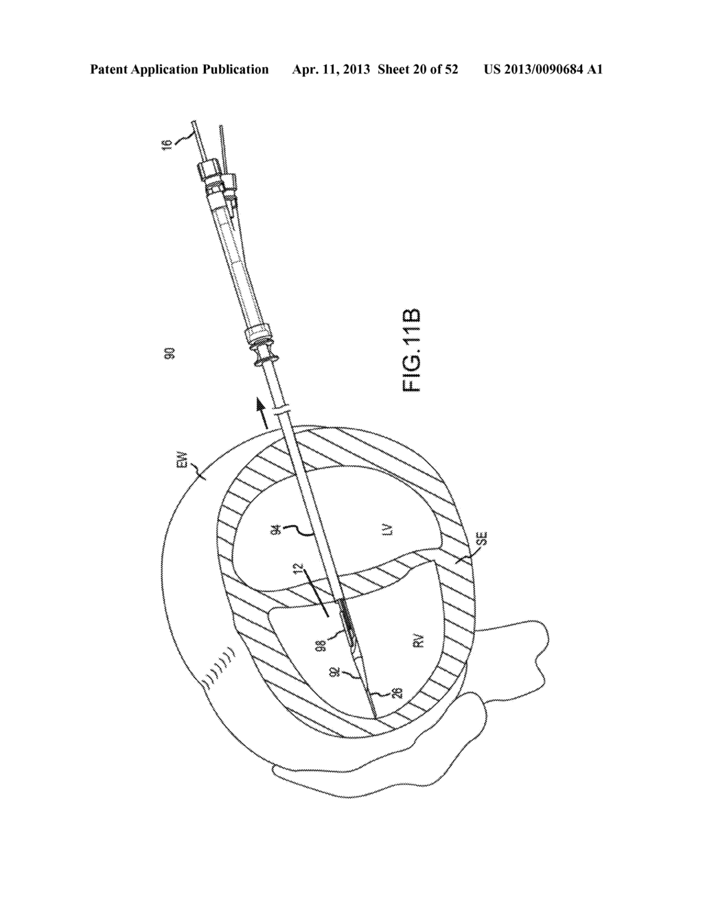 TRANS-CATHETER VENTRICULAR RECONSTRUCTION STRUCTURES, METHODS, AND SYSTEMS     FOR TREATMENT OF CONGESTIVE HEART FAILURE AND OTHER CONDITIONS - diagram, schematic, and image 21