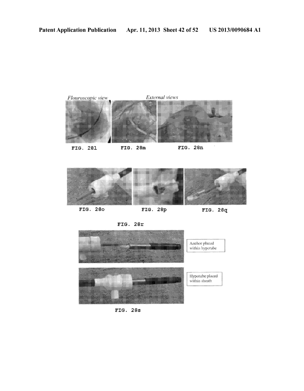 TRANS-CATHETER VENTRICULAR RECONSTRUCTION STRUCTURES, METHODS, AND SYSTEMS     FOR TREATMENT OF CONGESTIVE HEART FAILURE AND OTHER CONDITIONS - diagram, schematic, and image 43