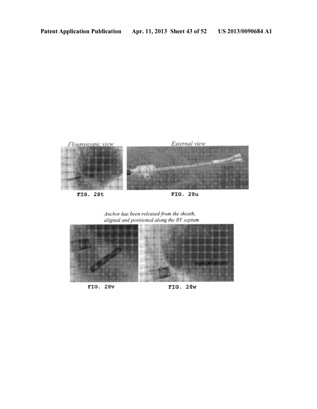 TRANS-CATHETER VENTRICULAR RECONSTRUCTION STRUCTURES, METHODS, AND SYSTEMS     FOR TREATMENT OF CONGESTIVE HEART FAILURE AND OTHER CONDITIONS - diagram, schematic, and image 44