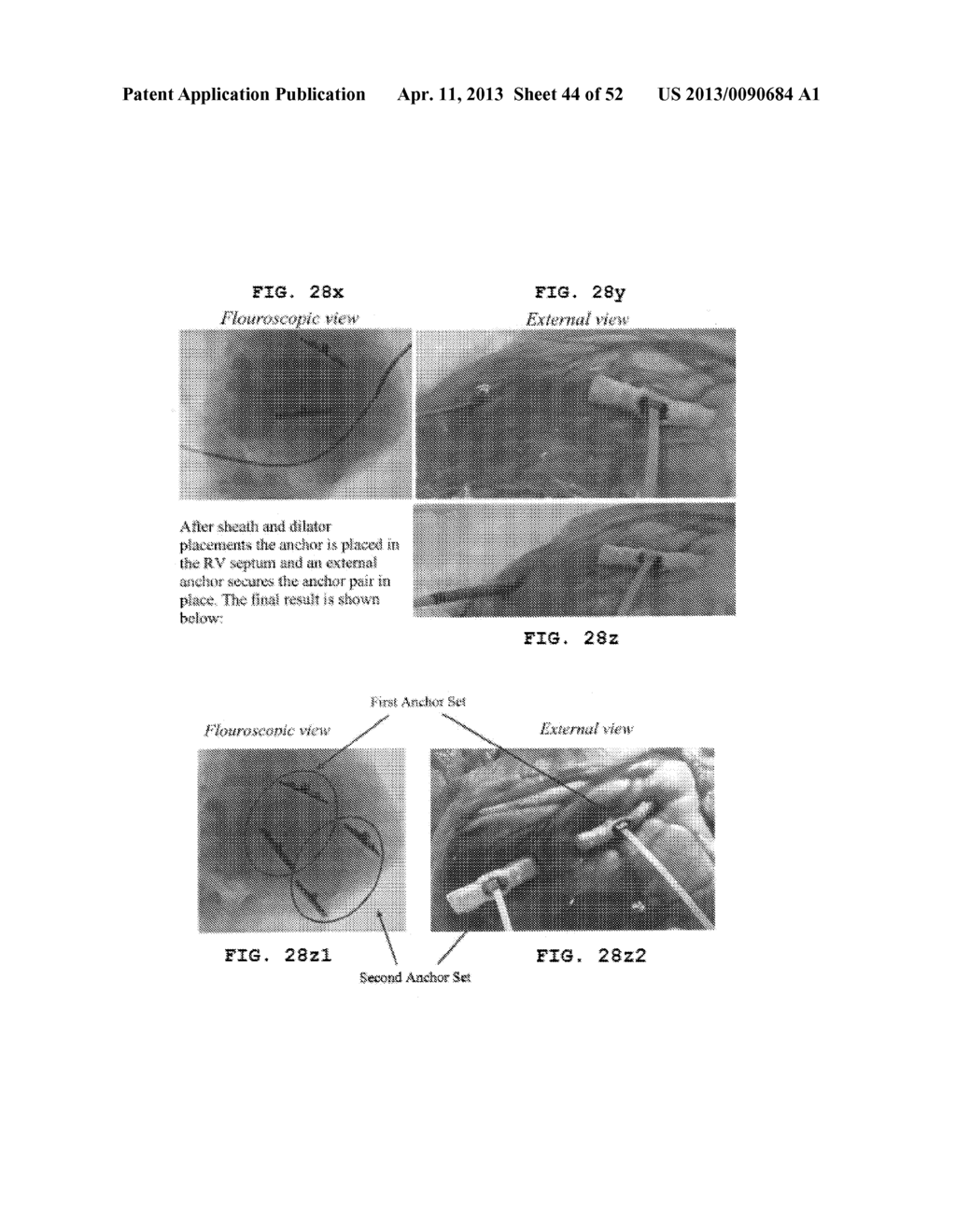 TRANS-CATHETER VENTRICULAR RECONSTRUCTION STRUCTURES, METHODS, AND SYSTEMS     FOR TREATMENT OF CONGESTIVE HEART FAILURE AND OTHER CONDITIONS - diagram, schematic, and image 45