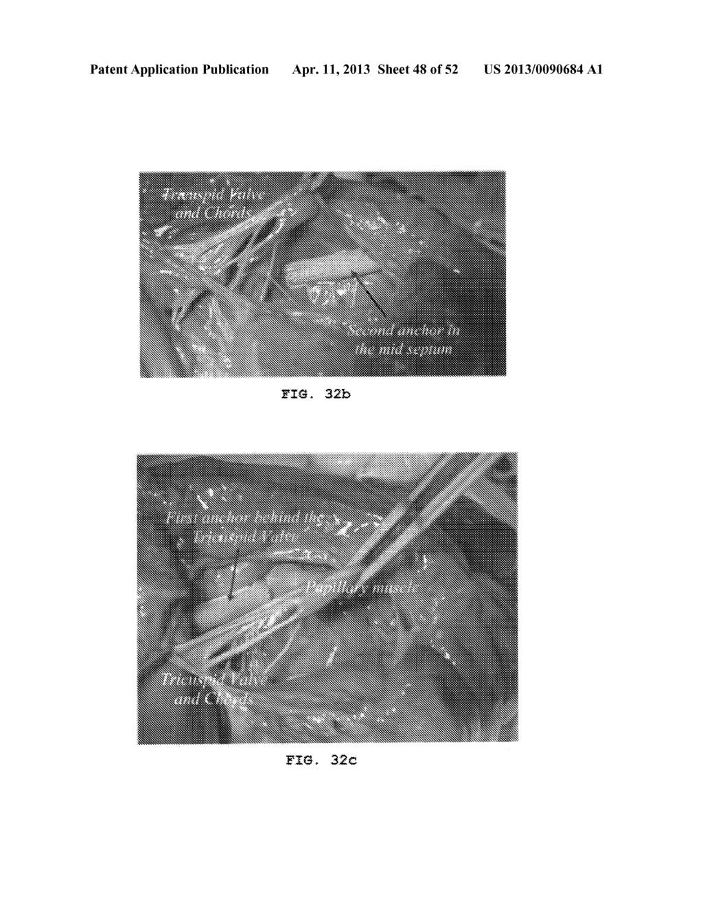 TRANS-CATHETER VENTRICULAR RECONSTRUCTION STRUCTURES, METHODS, AND SYSTEMS     FOR TREATMENT OF CONGESTIVE HEART FAILURE AND OTHER CONDITIONS - diagram, schematic, and image 49