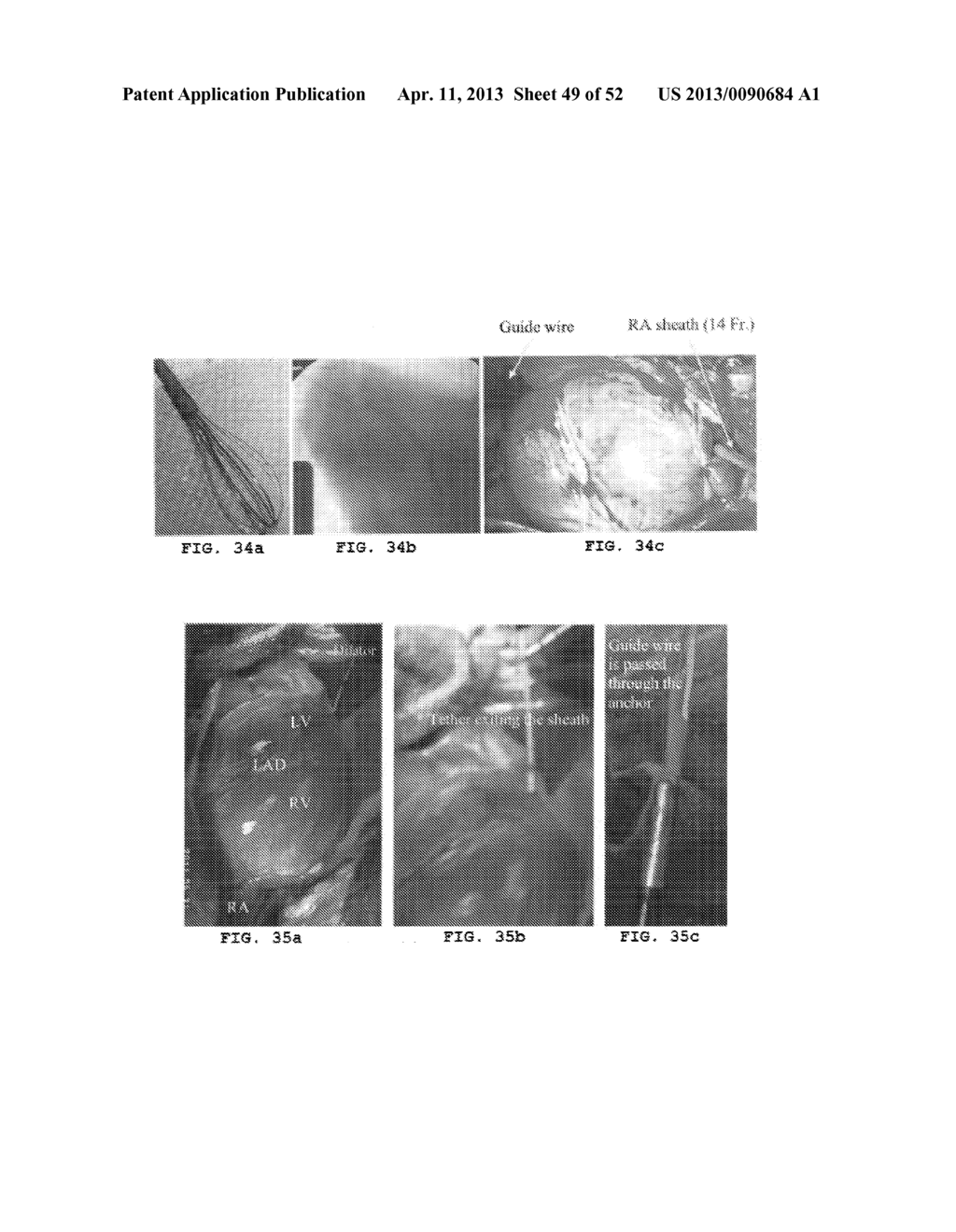 TRANS-CATHETER VENTRICULAR RECONSTRUCTION STRUCTURES, METHODS, AND SYSTEMS     FOR TREATMENT OF CONGESTIVE HEART FAILURE AND OTHER CONDITIONS - diagram, schematic, and image 50