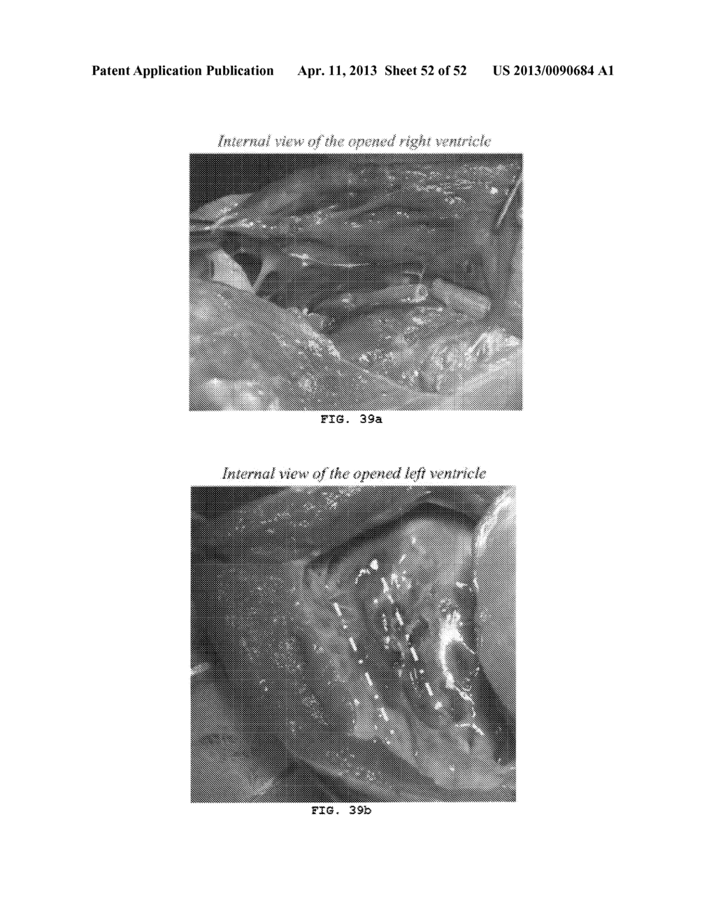 TRANS-CATHETER VENTRICULAR RECONSTRUCTION STRUCTURES, METHODS, AND SYSTEMS     FOR TREATMENT OF CONGESTIVE HEART FAILURE AND OTHER CONDITIONS - diagram, schematic, and image 53