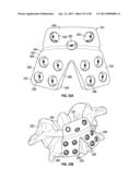 POSTERIOR VERTEBRAL PLATING SYSTEM diagram and image