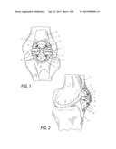 LOW PROFILE PERIARTICULAR TENSION BAND PLATING SYSTEM WITH SOFT TISSUE     NEUTRALIZATION CABLE TUNNEL/CHANNEL diagram and image