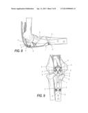 LOW PROFILE PERIARTICULAR TENSION BAND PLATING SYSTEM WITH SOFT TISSUE     NEUTRALIZATION CABLE TUNNEL/CHANNEL diagram and image