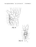 LOW PROFILE PERIARTICULAR TENSION BAND PLATING SYSTEM WITH SOFT TISSUE     NEUTRALIZATION CABLE TUNNEL/CHANNEL diagram and image