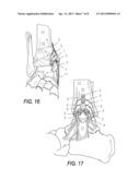 LOW PROFILE PERIARTICULAR TENSION BAND PLATING SYSTEM WITH SOFT TISSUE     NEUTRALIZATION CABLE TUNNEL/CHANNEL diagram and image